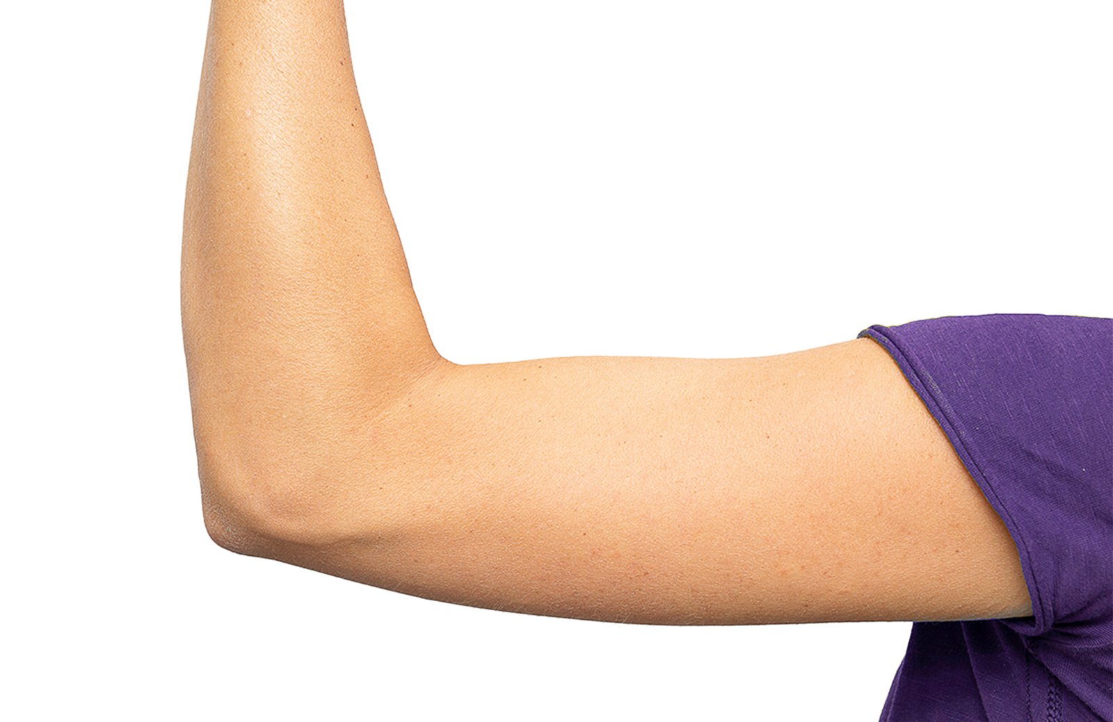 Arm Lift CASe final
