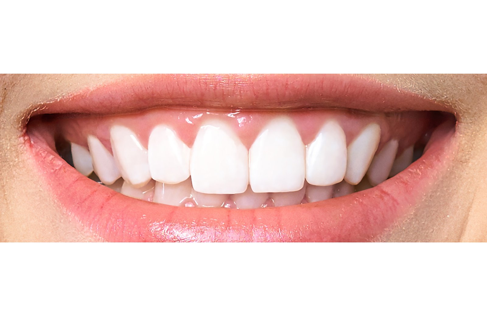 Hollywood Smile CASe final