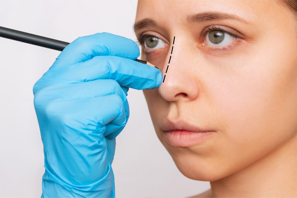 Rhinoplasty FINAL4